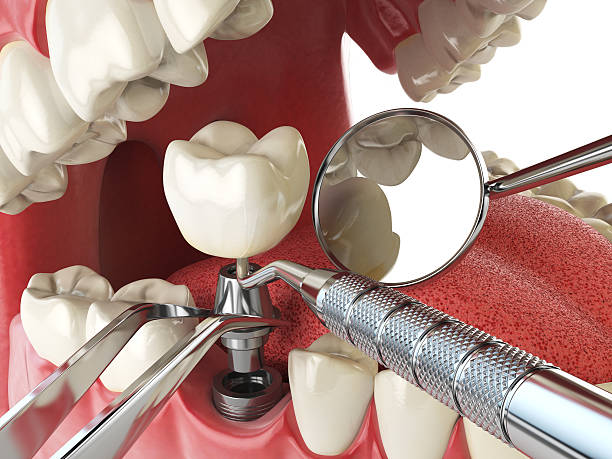 Best Emergency Root Canal Treatment in Lake Holiday, IL
